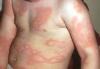 Are there any Oxyhives Australia side effects?