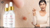What is the Amarose Skin Tag Remover?